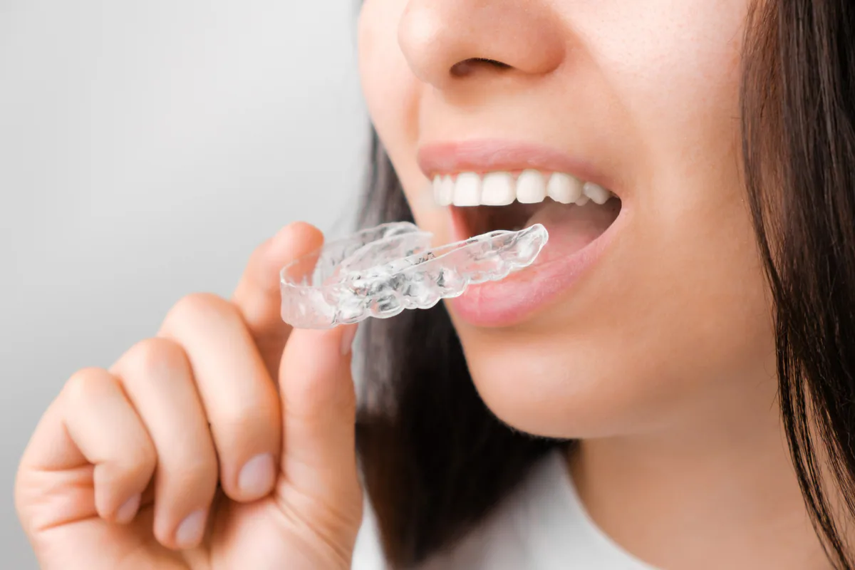 Custom-made clear aligners gradually move teeth into better positions.