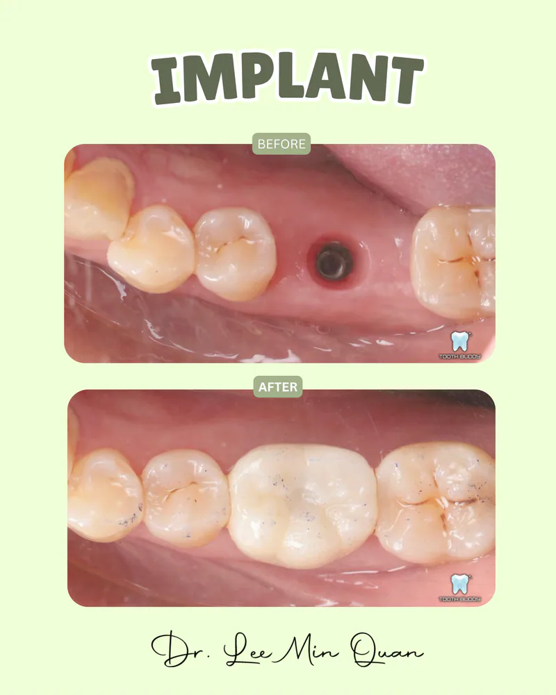 Dental implant treatment result 1, before and after comparison.