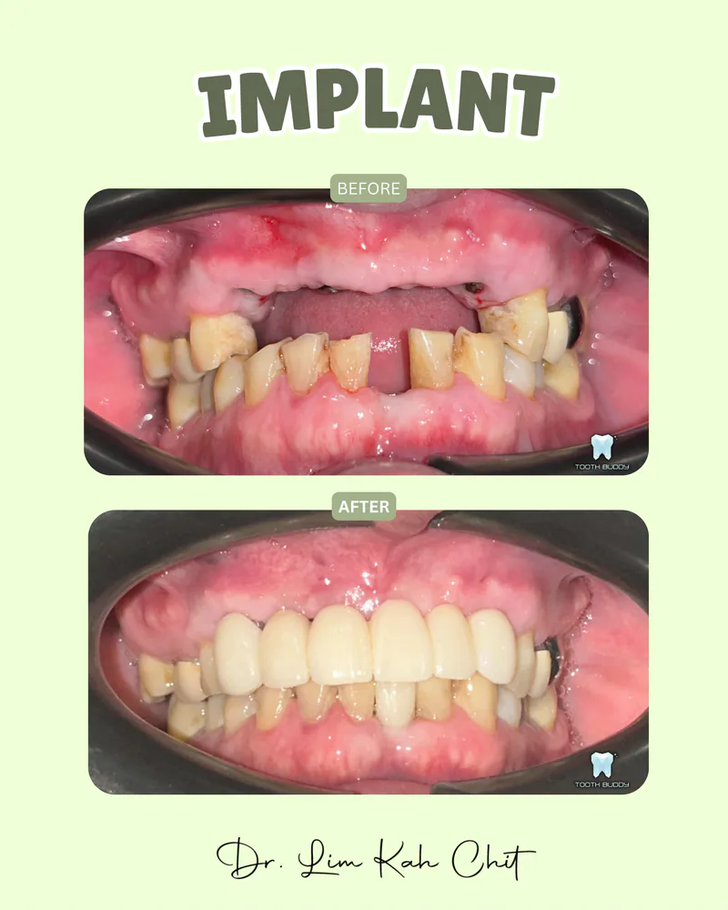 Dental implant treatment result 4, before and after comparison.