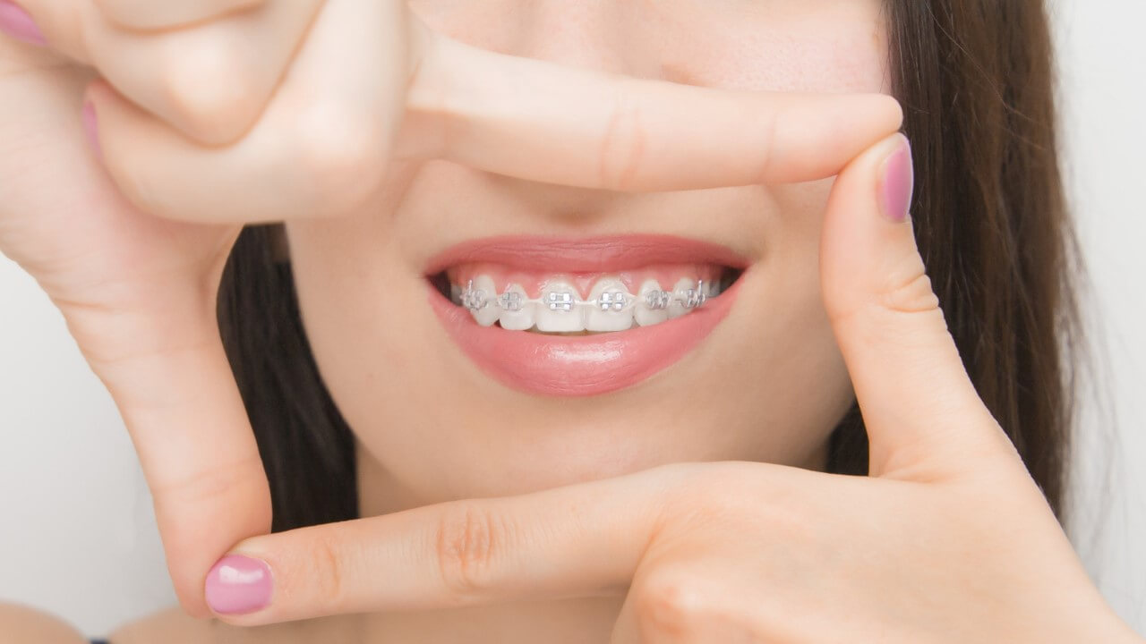 Damon self-ligating braces utilize a unique clip system to hold the wire in place, promoting faster tooth movement and reducing the need for frequent adjustments.