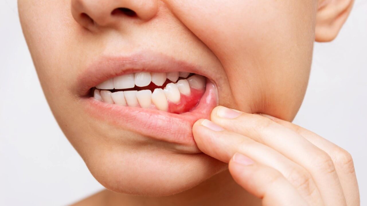 At Tooth Buddy Dental Clinic, our gum disease treatment focuses on eliminating infection and inflammation to restore gum health and prevent tooth loss.