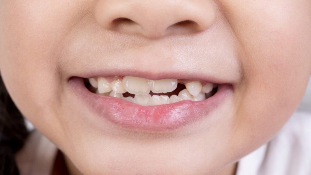 Tooth Buddy provides early solutions for crooked teeth to promote straighter smiles.