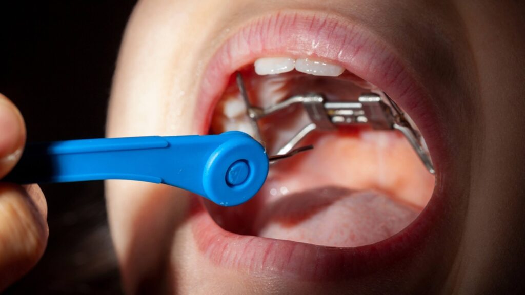 Tooth Buddy uses expanders to gently create space for healthier tooth and facial development in kids.
