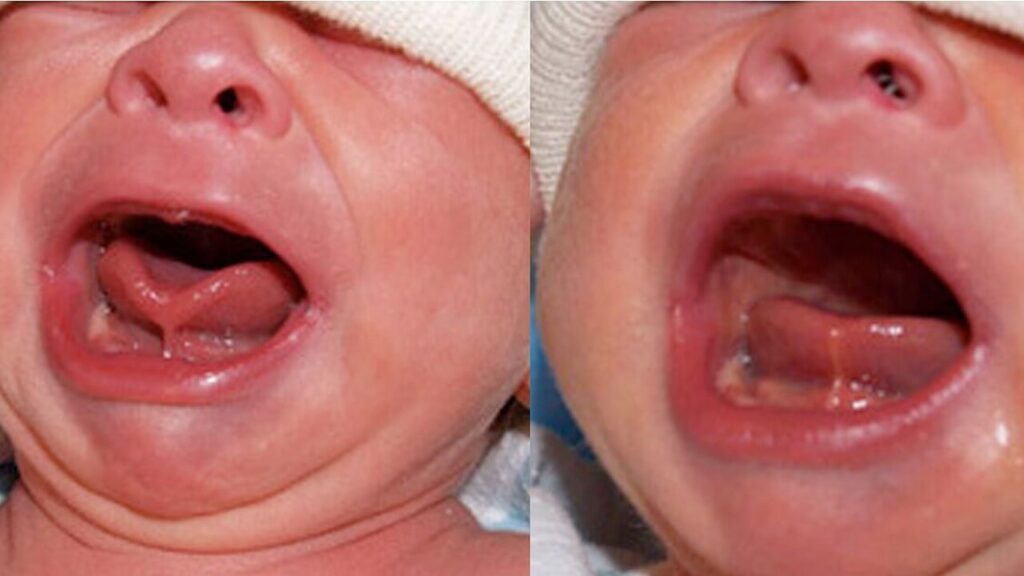 Tooth Buddy identifies and treats tongue tie issues affecting speech and feeding in children.