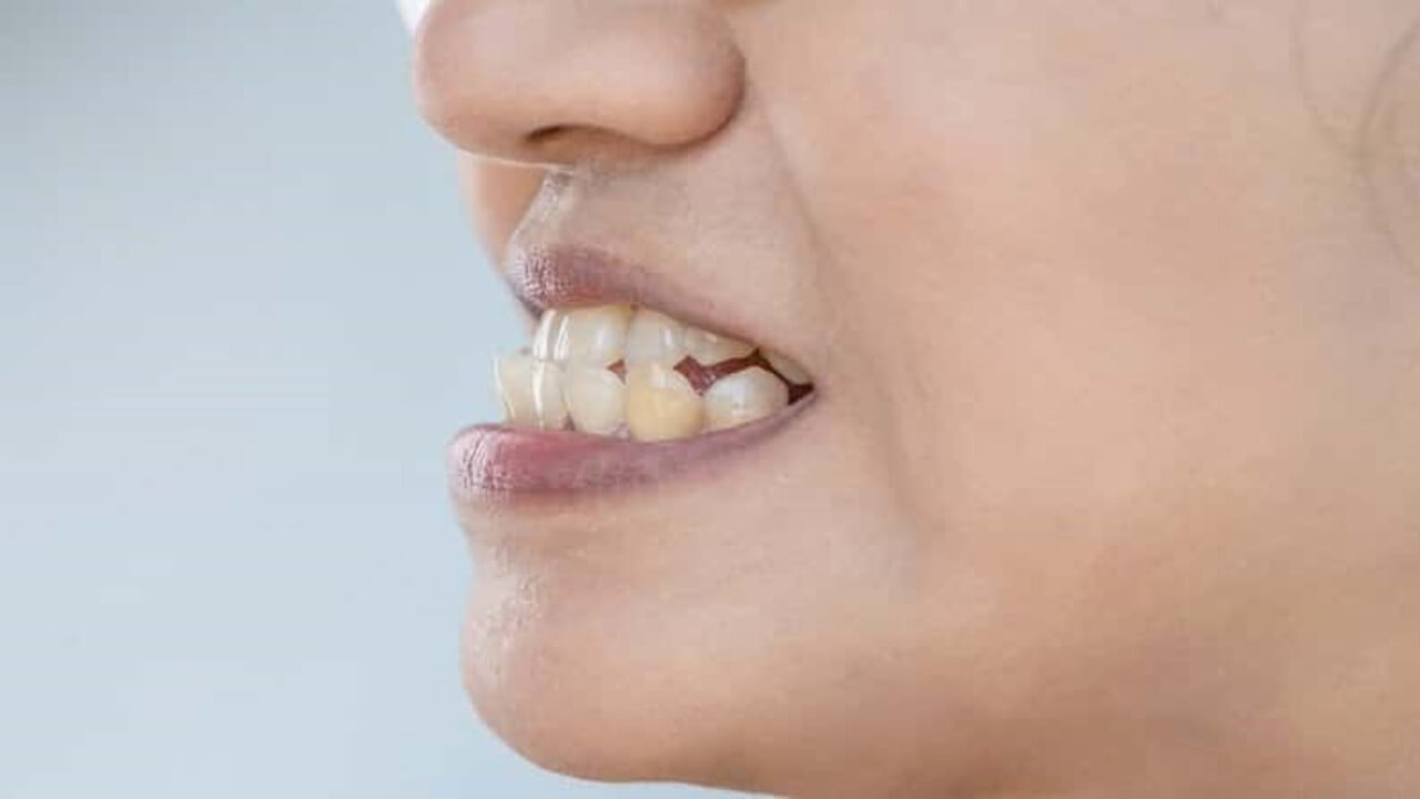 Tooth Buddy helps correct underbite issues early to support balanced facial growth.